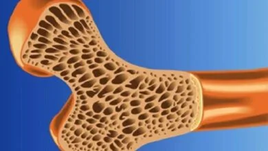 شکستگی، تنها نشانه پوکی استخوان است شکستگی، تنها نشانه پوکی استخوان است