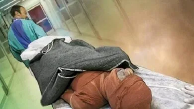 لزوم حمایت از بیماران سوخته / ضرورت راه اندازی بانک پوست در کشور