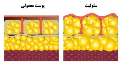 آیا سلولیت در خانه قابل درمان است؟ بهترین روش درمان سلولیت در منزل