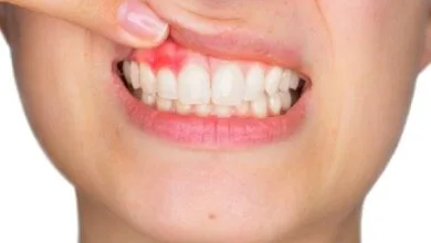 دلایل خونریزی لثه چیست؟ برای درمان آن چه کنیم؟