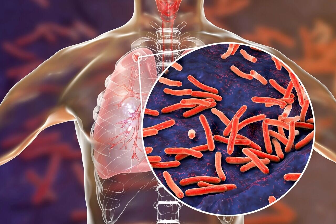 خدمات درمانی رایگان برای این ۷هزار بیمار | سل چگونه از بیمار به فرد سالم منتقل می شود؟